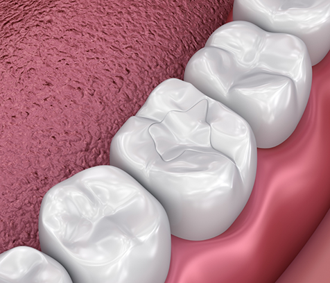 Illustration of tooth with a metal-free filling