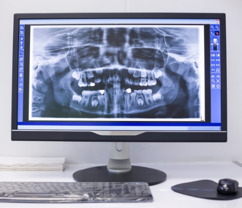 X-ray of teeth on computer screen