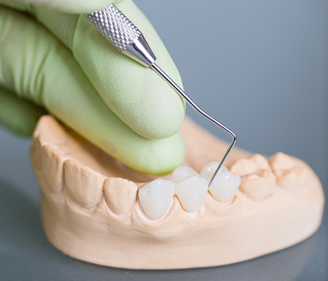 Using dental explorer tool on dental bridge on model of missing teeth