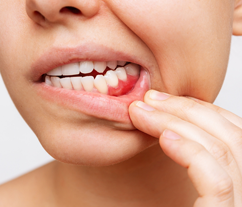 Close-up of woman pulling down lip to show gums