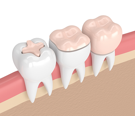 Illustration of teeth with dental crowns and other forms of restorative dentistry in Campbell